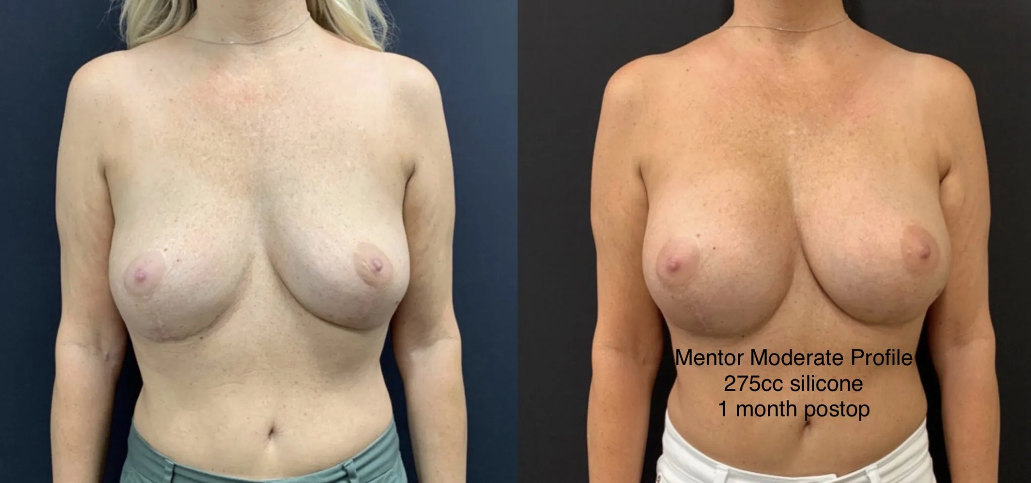 BREAST AUGMENTATION Before & After Case Number 00012