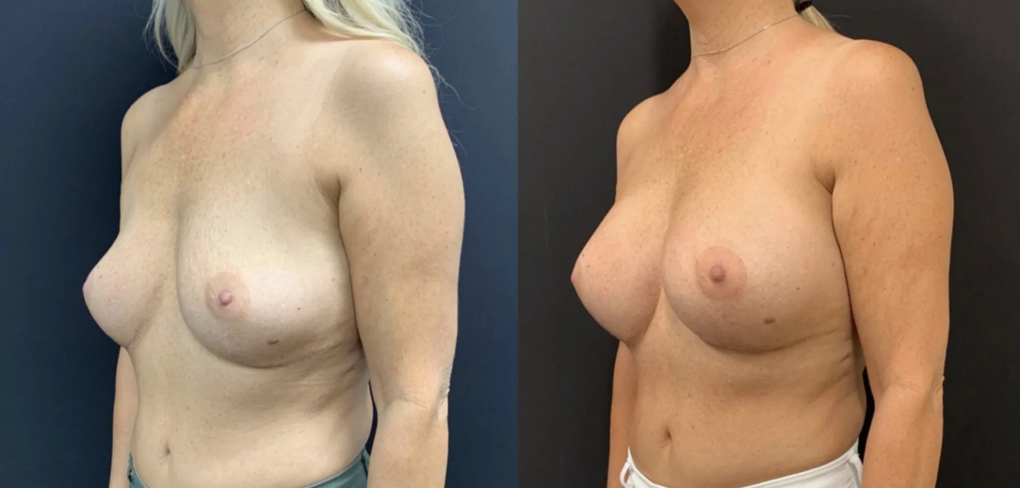 BREAST AUGMENTATION Before & After Case Number 00012