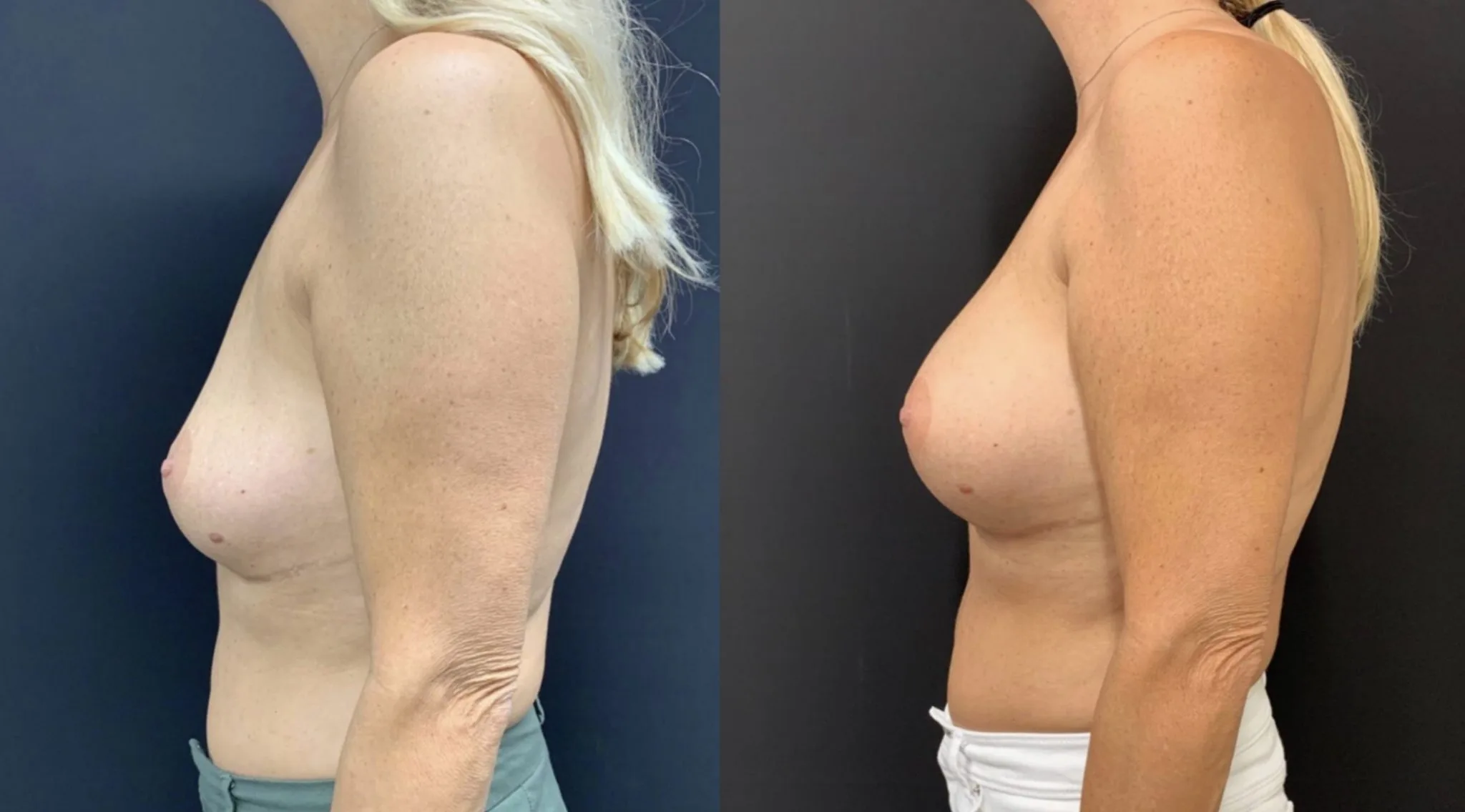BREAST AUGMENTATION Before & After Case Number 00012