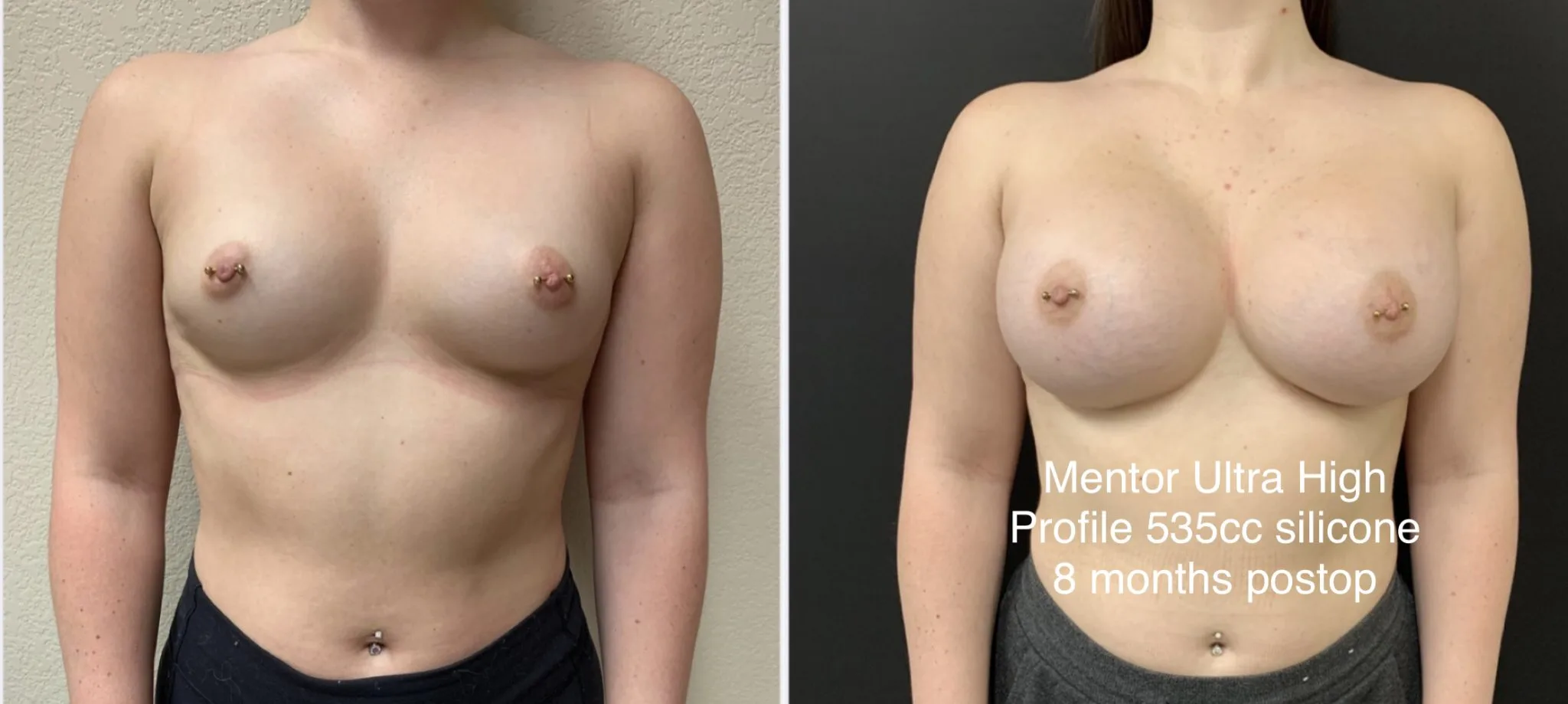 BREAST AUGMENTATION Before & After Case Number 00016