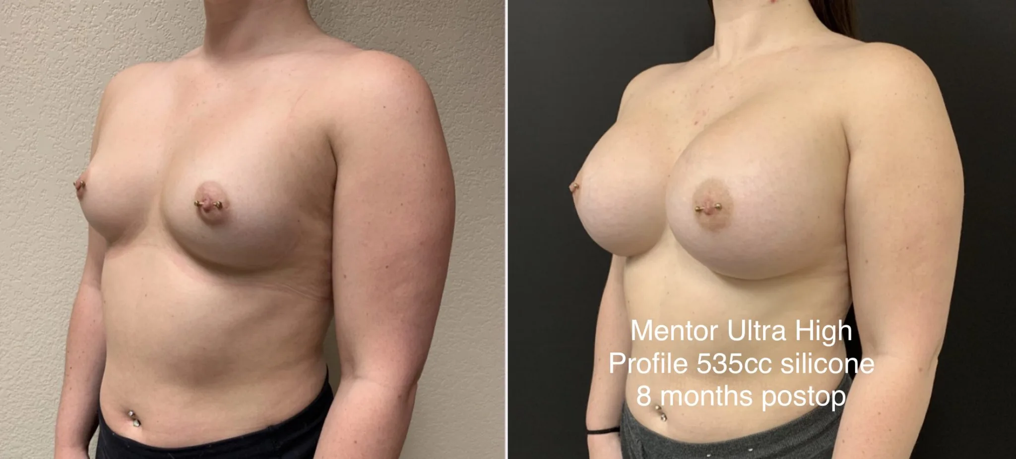 BREAST AUGMENTATION Before & After Case Number 00016