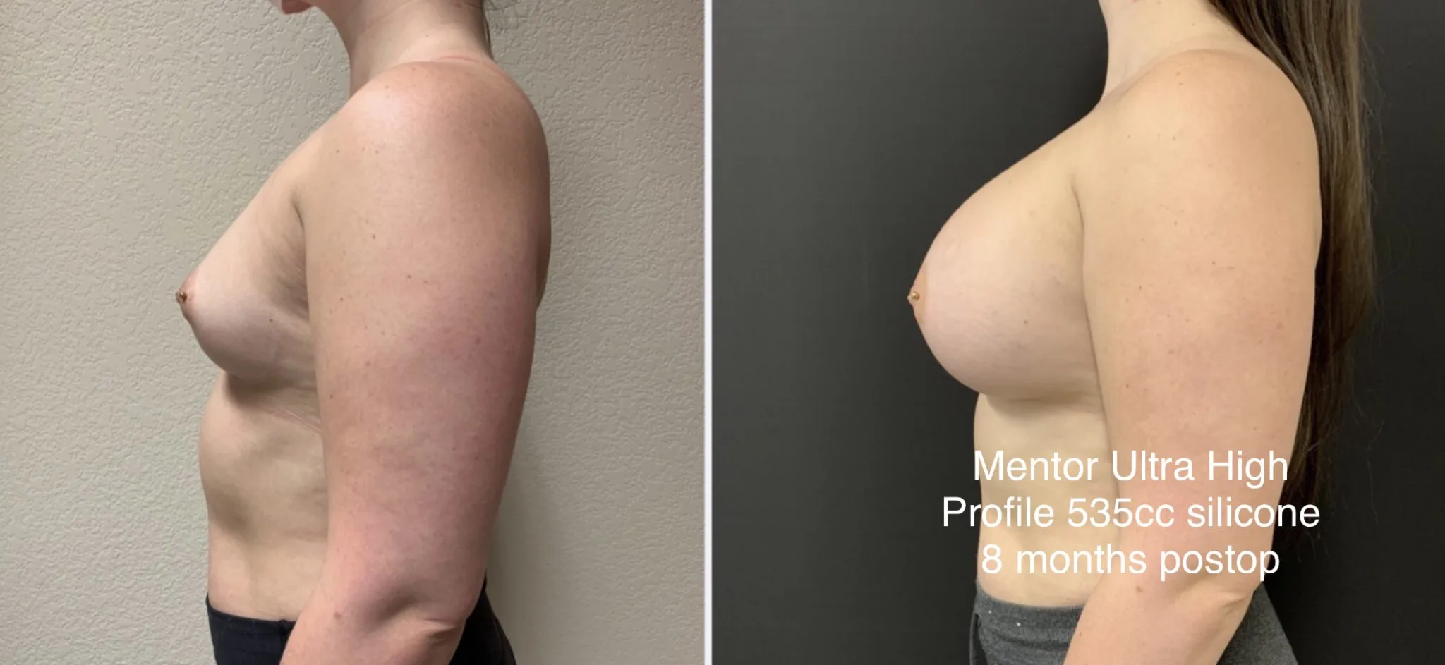 BREAST AUGMENTATION Before & After Case Number 00016