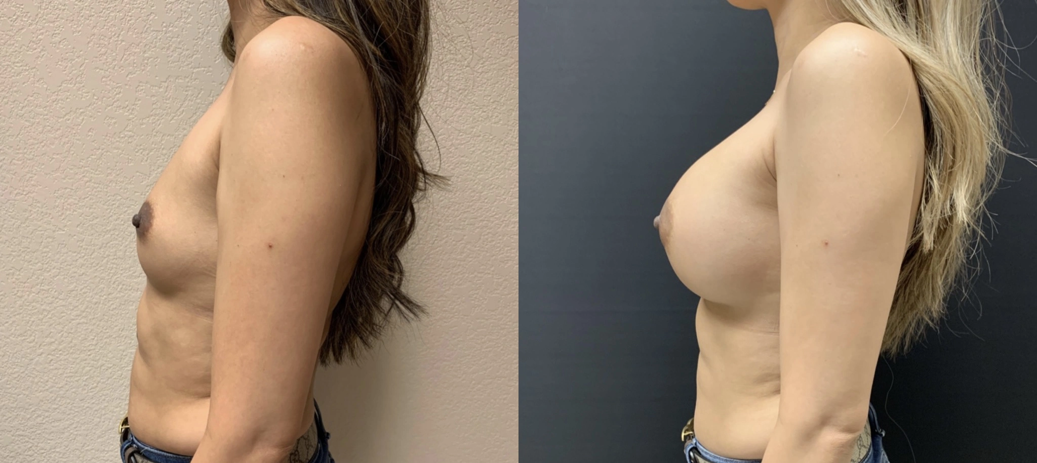 BREAST AUGMENTATION Before & After Case Number 00017