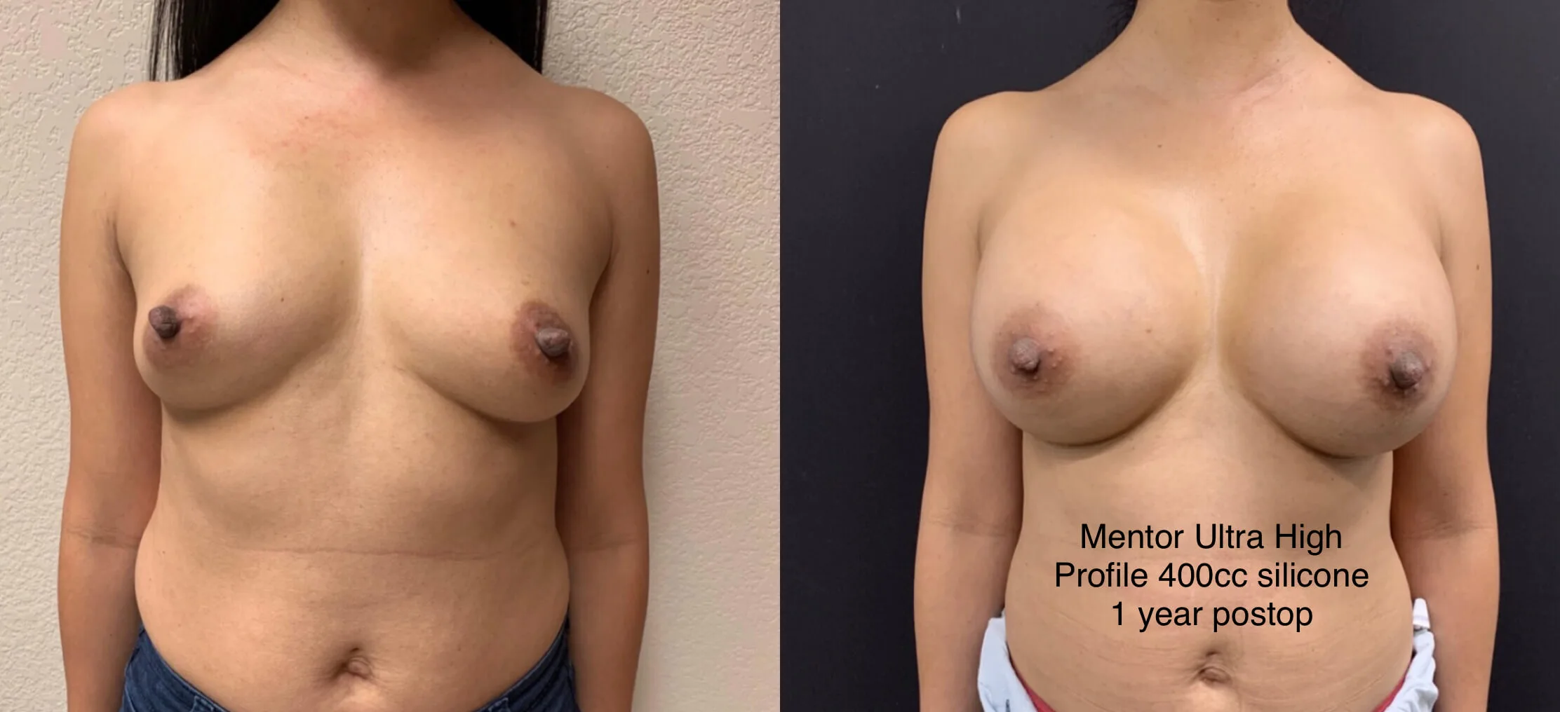 Breast Augmentation Before & After Case Number 0002