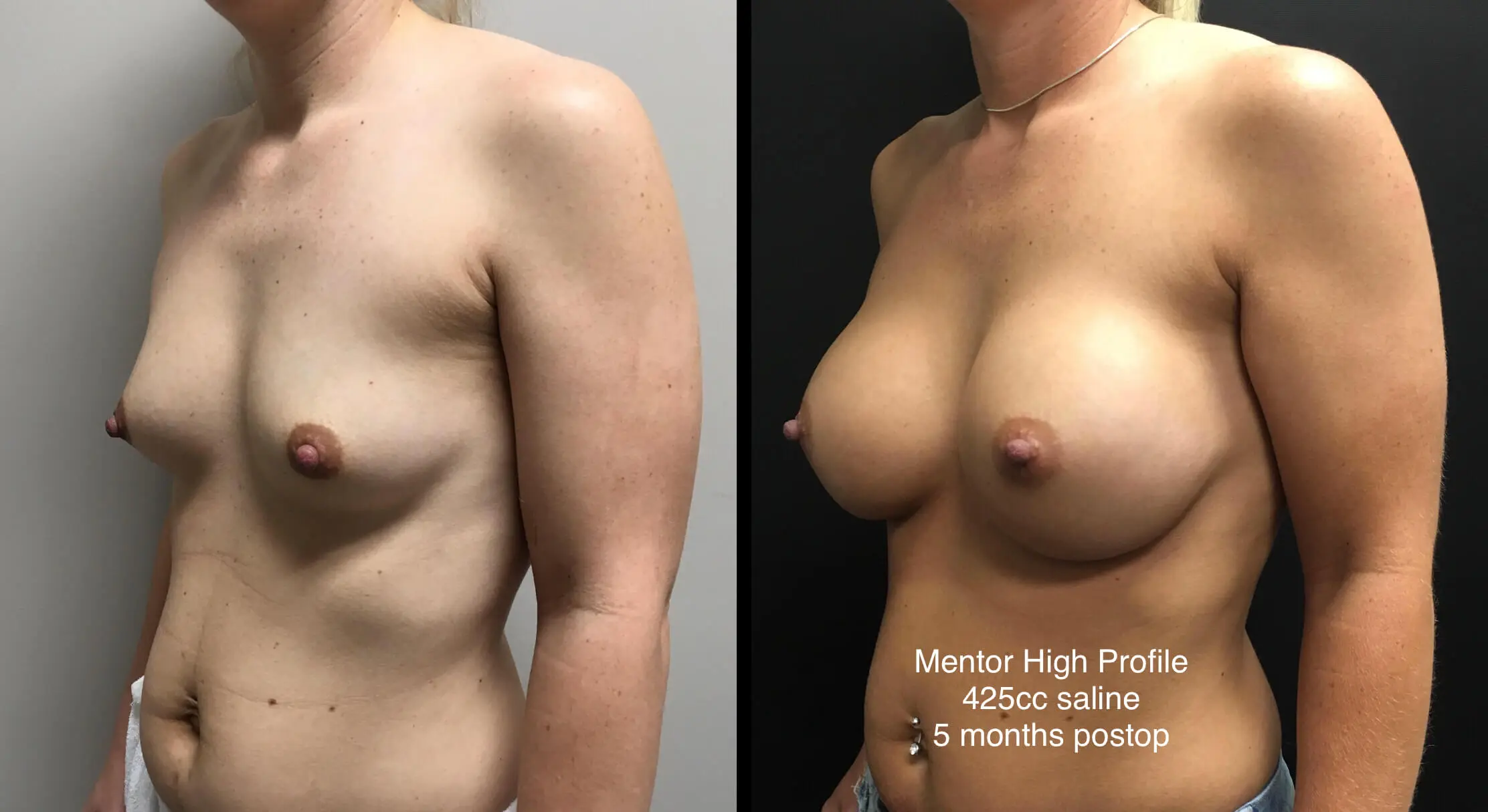 BREAST AUGMENTATION Before & After Case Number 00020