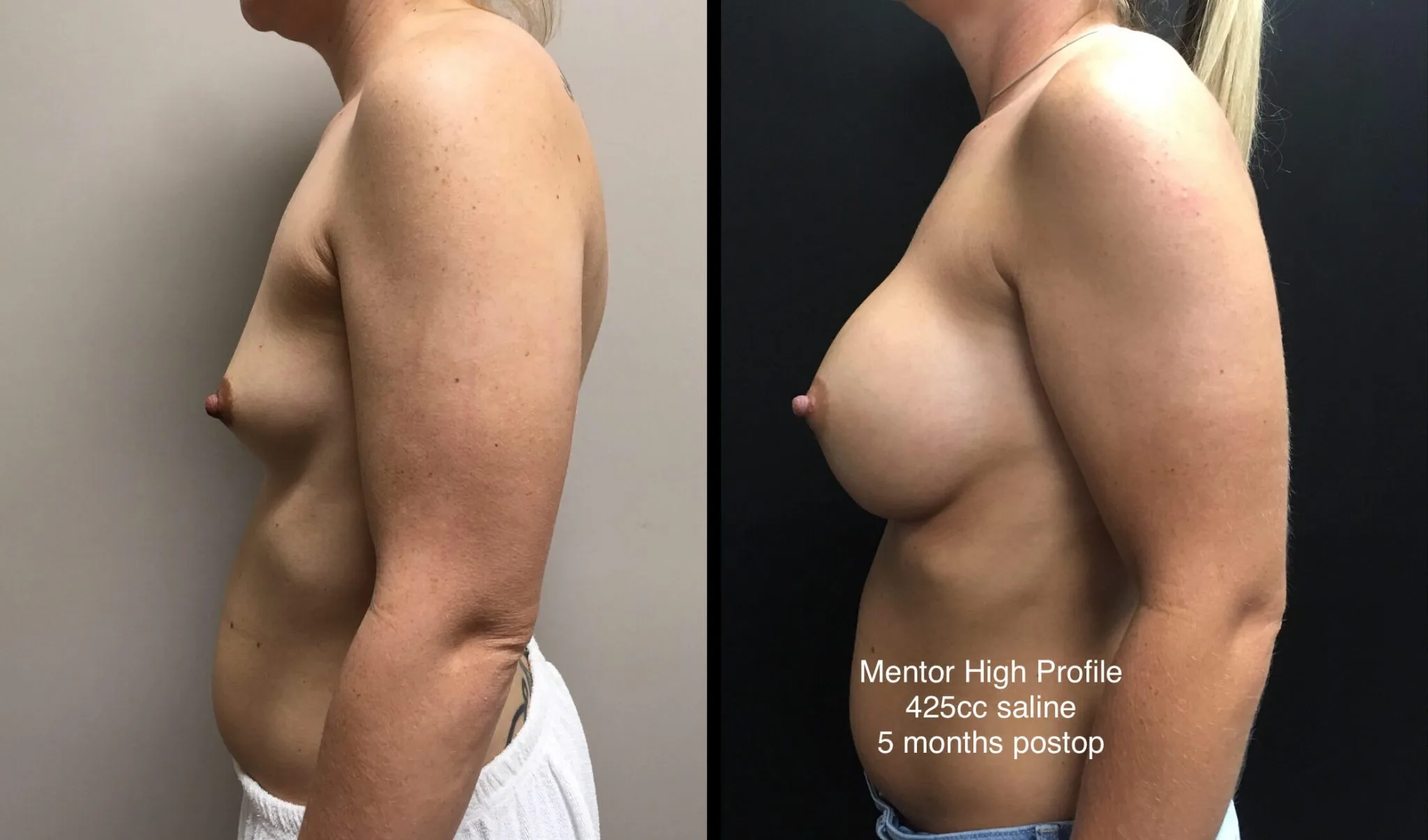 BREAST AUGMENTATION Before & After Case Number 00020