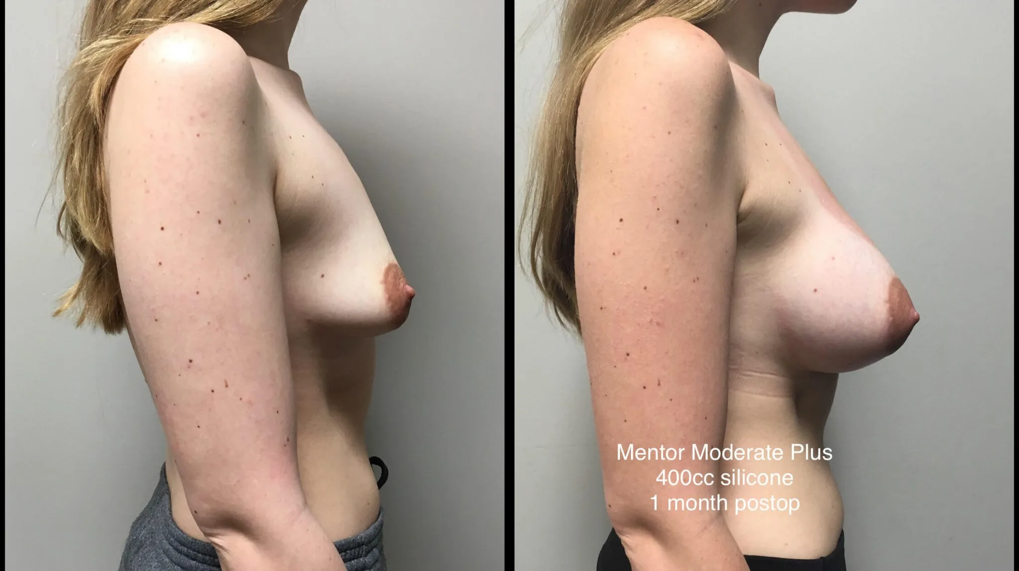 BREAST AUGMENTATION Before & After Case Number 00022