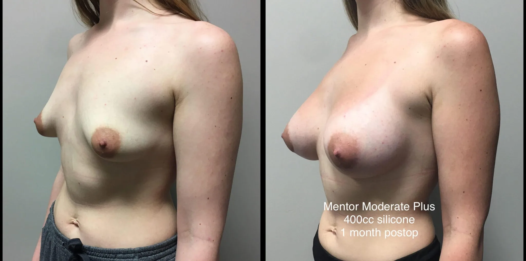 BREAST AUGMENTATION Before & After Case Number 00022