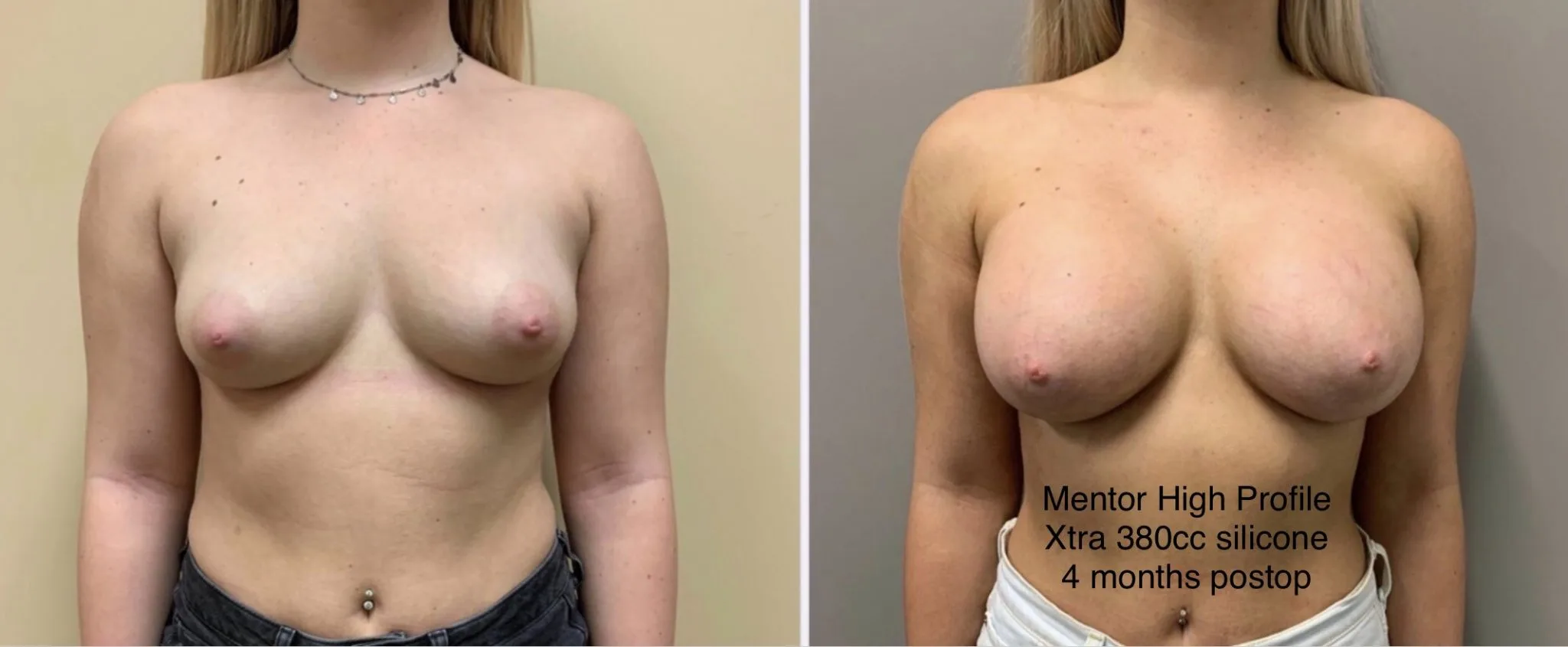 BREAST AUGMENTATION Before & After Case Number 00024