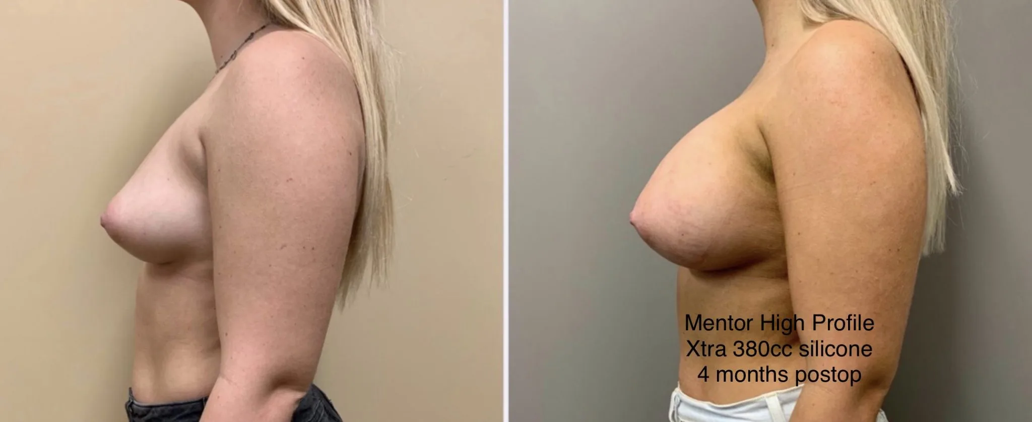 BREAST AUGMENTATION Before & After Case Number 00024