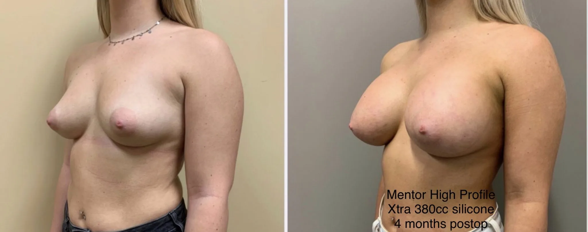 BREAST AUGMENTATION Before & After Case Number 00024