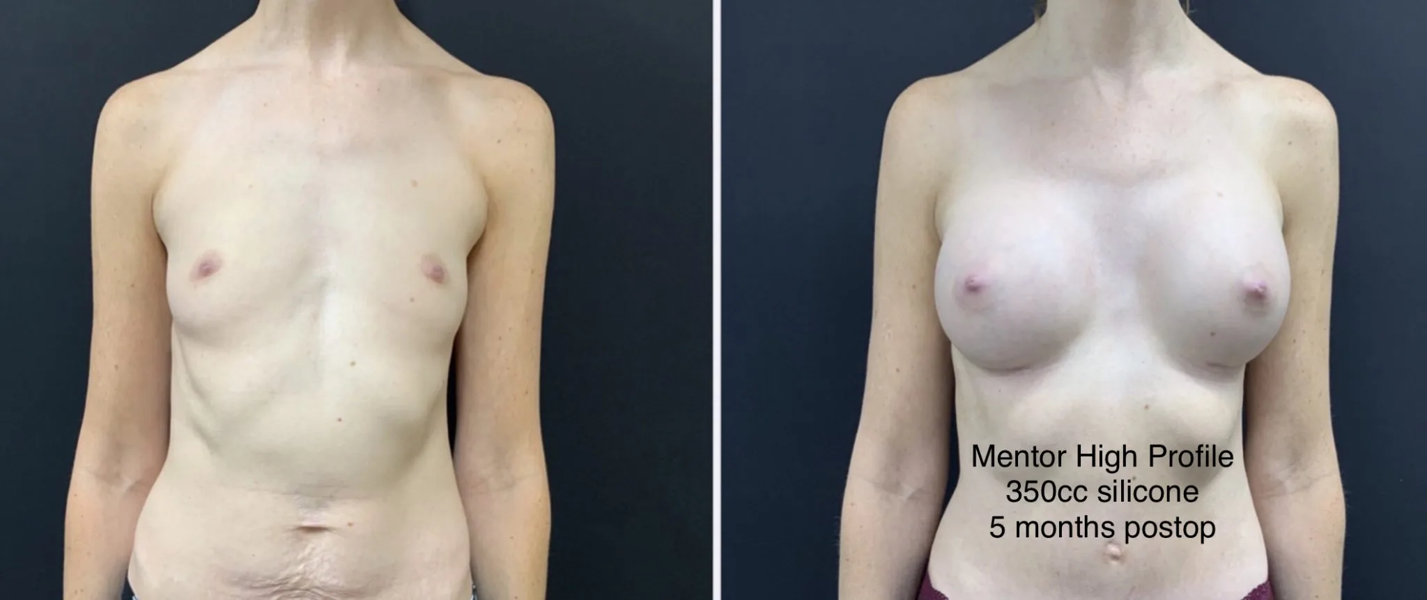 BREAST AUGMENTATION Before & After Case Number 00028