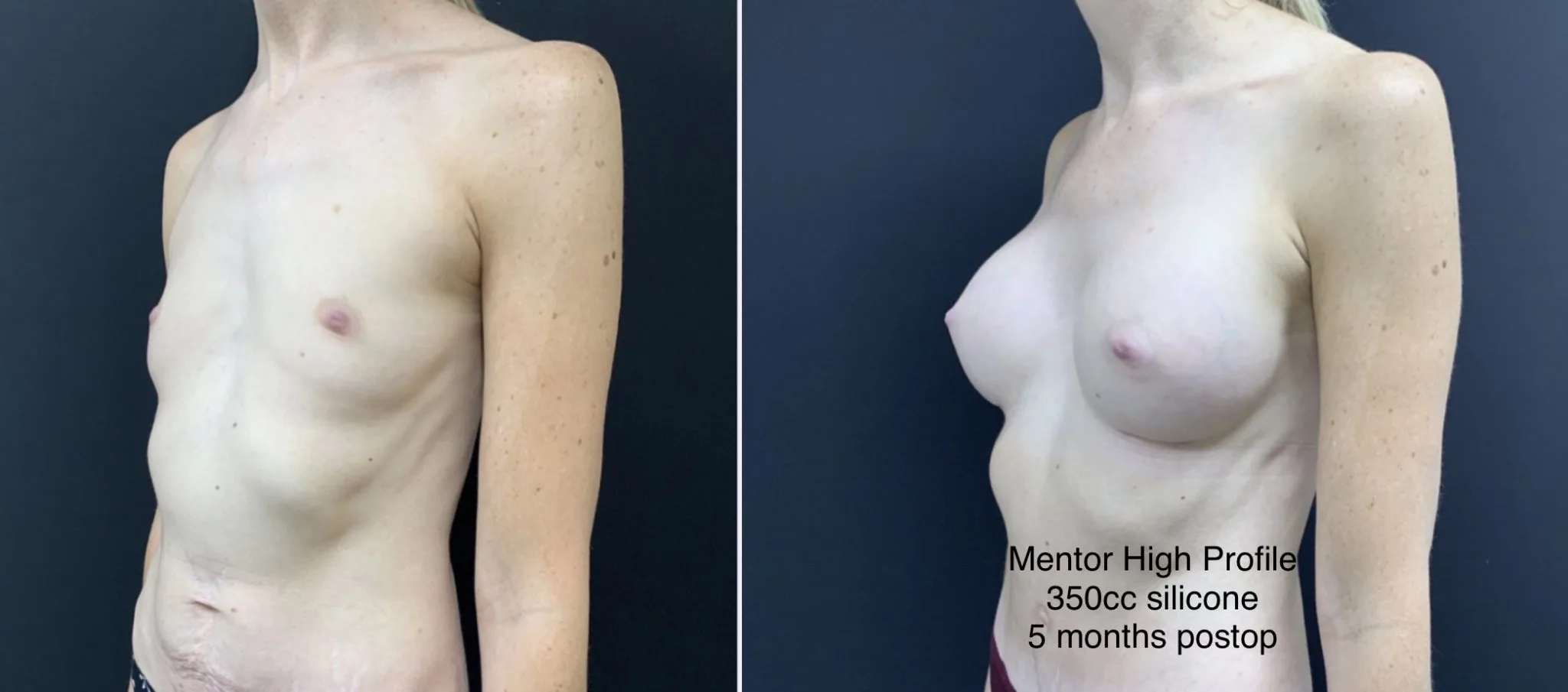 BREAST AUGMENTATION Before & After Case Number 00028