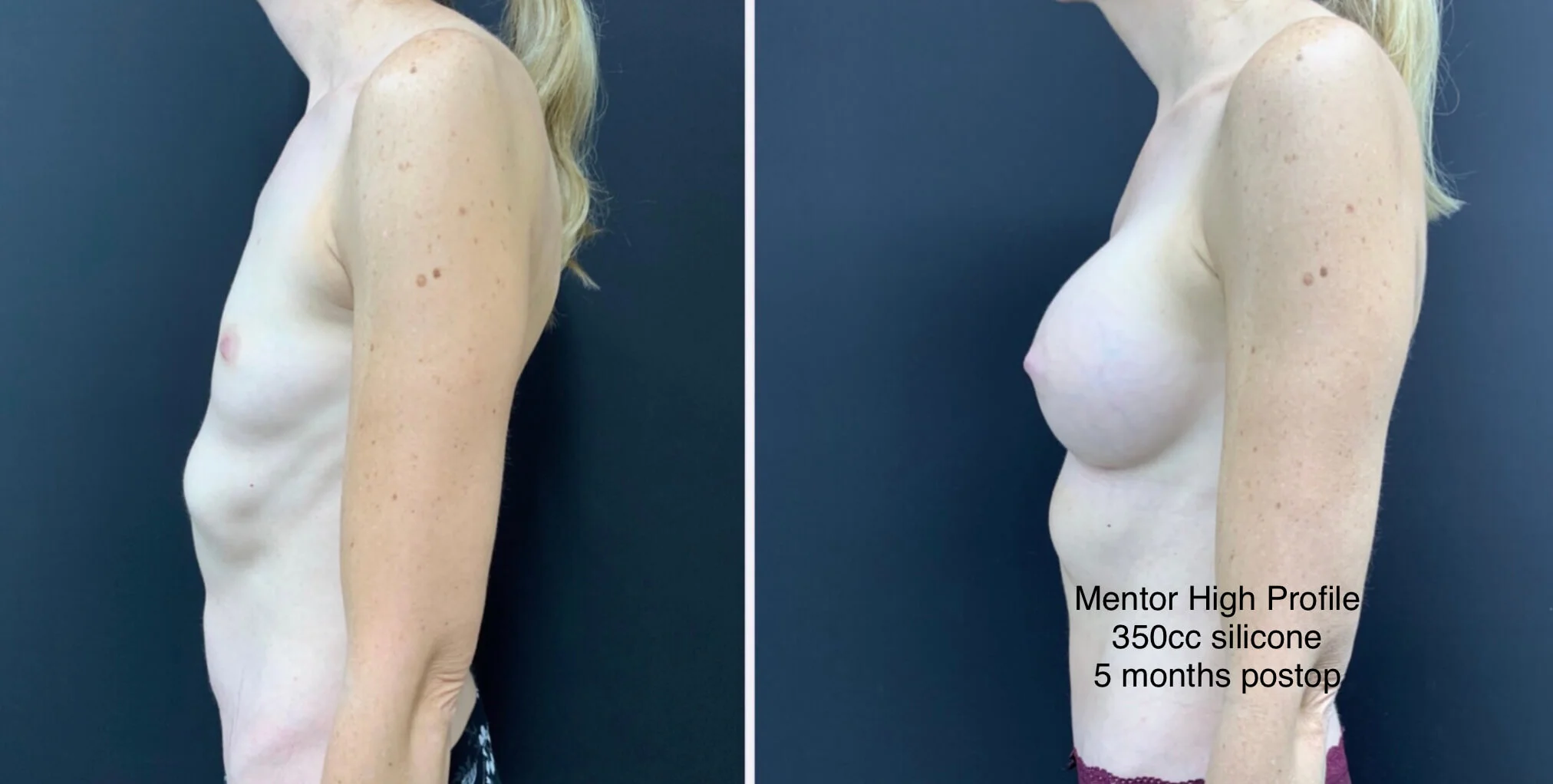 BREAST AUGMENTATION Before & After Case Number 00028