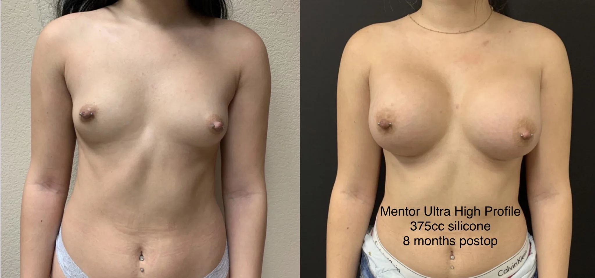 BREAST AUGMENTATION Before & After Case Number 00030