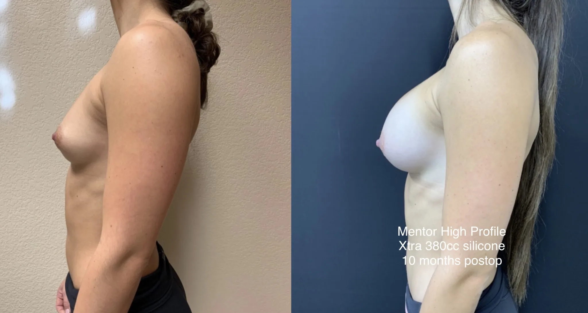 BREAST AUGMENTATION Before & After Case Number 00033