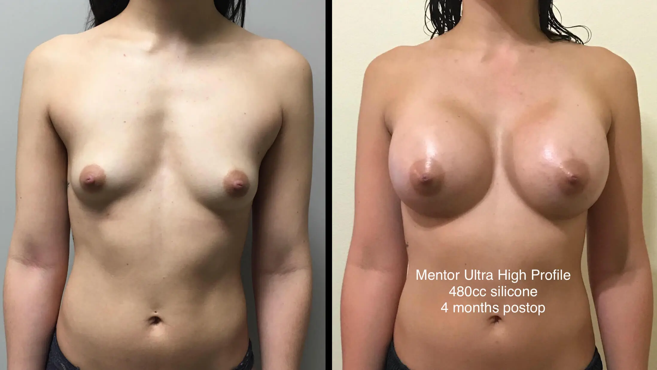 BREAST AUGMENTATION Before & After Case Number 00035