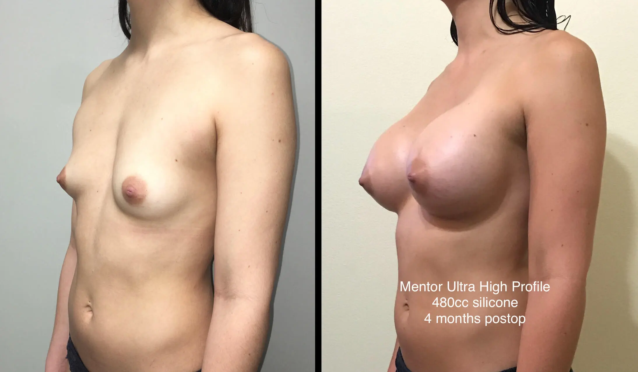 BREAST AUGMENTATION Before & After Case Number 00035