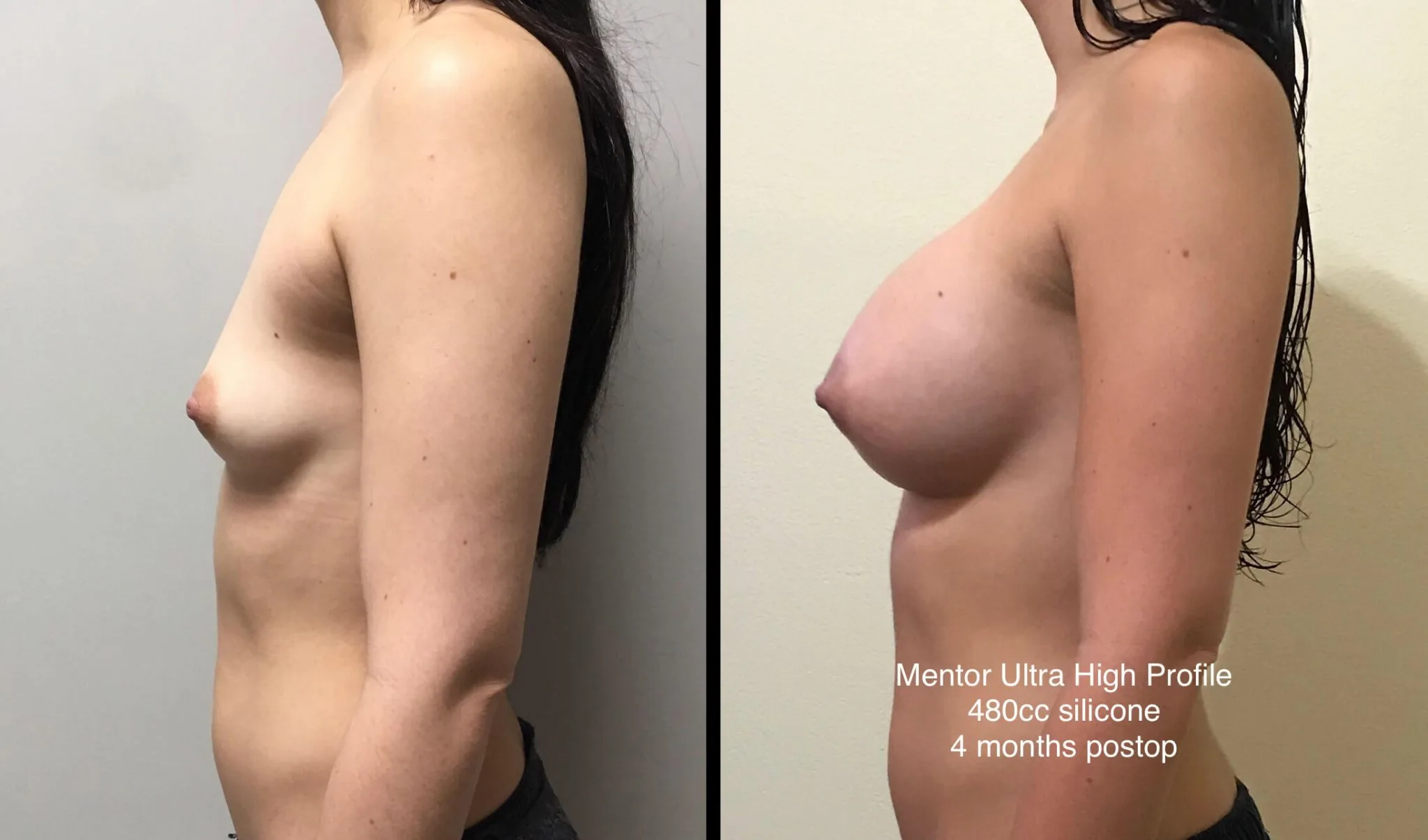 BREAST AUGMENTATION Before & After Case Number 00035