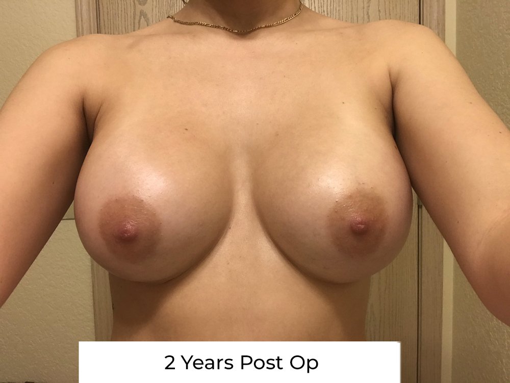 BREAST AUGMENTATION Before & After Case Number 00035