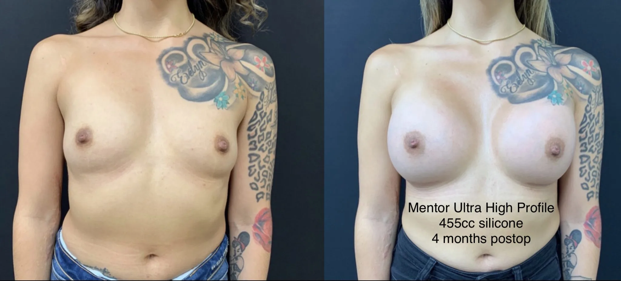 BREAST AUGMENTATION Before & After Case Number 00036