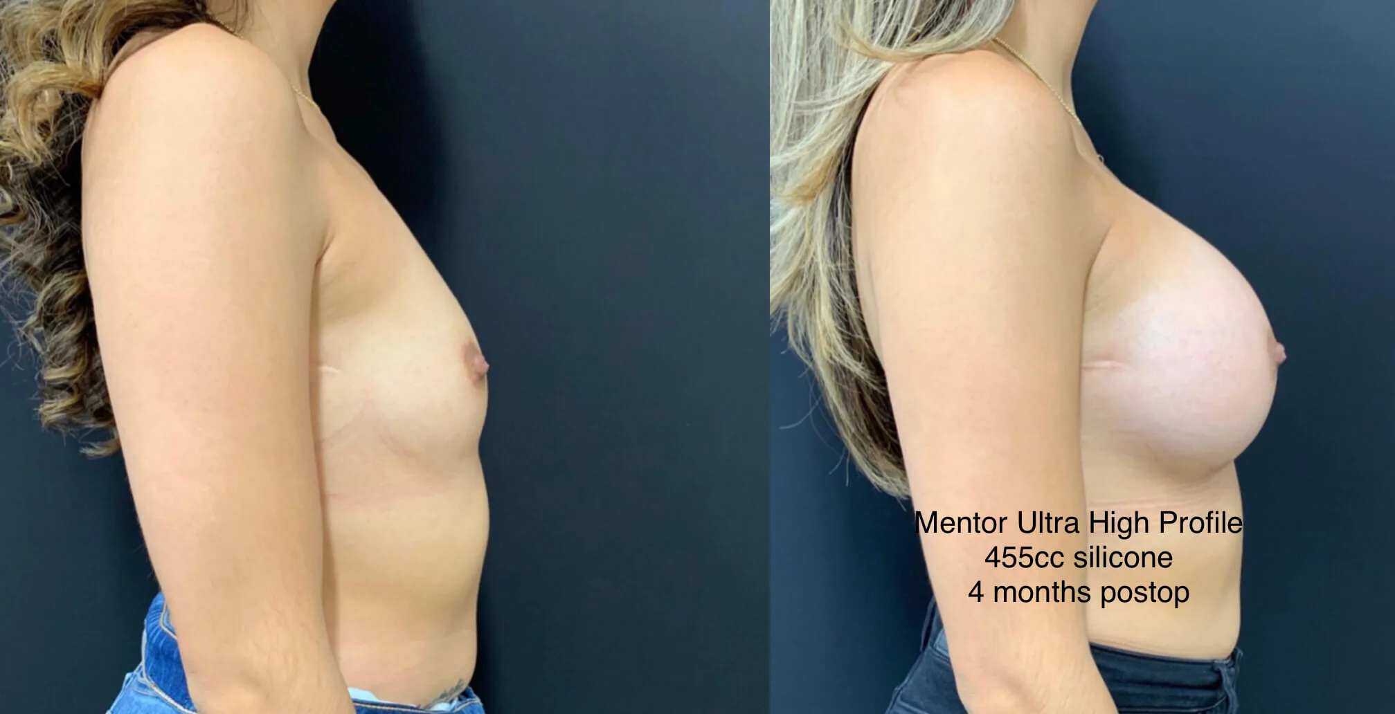 BREAST AUGMENTATION Before & After Case Number 00036