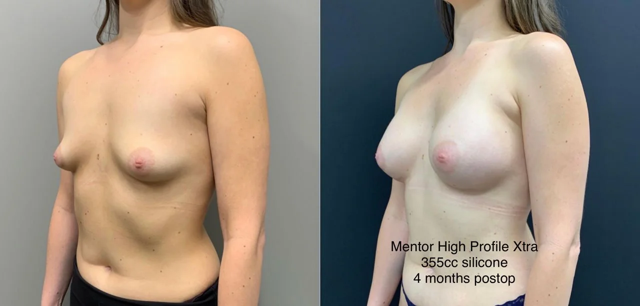 BREAST AUGMENTATION Before & After Case Number 00038