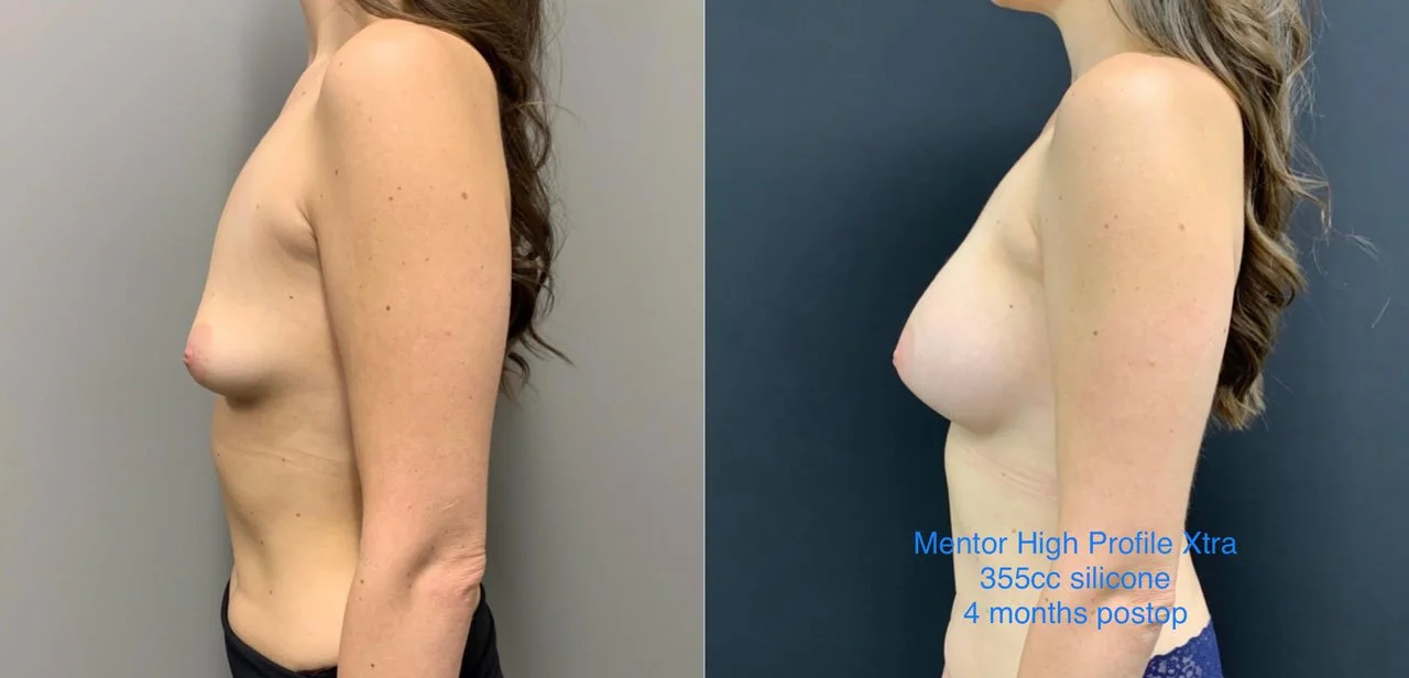 BREAST AUGMENTATION Before & After Case Number 00038