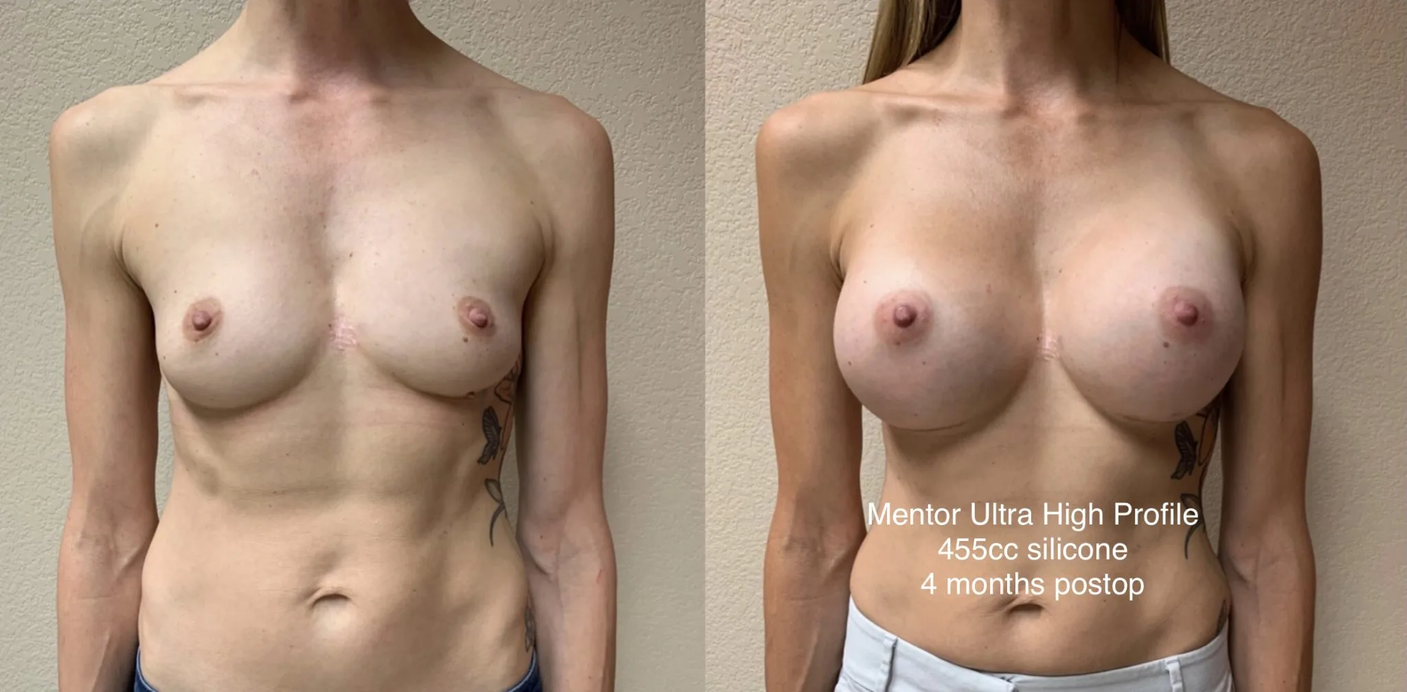 BREAST AUGMENTATION Before & After Case Number 00045