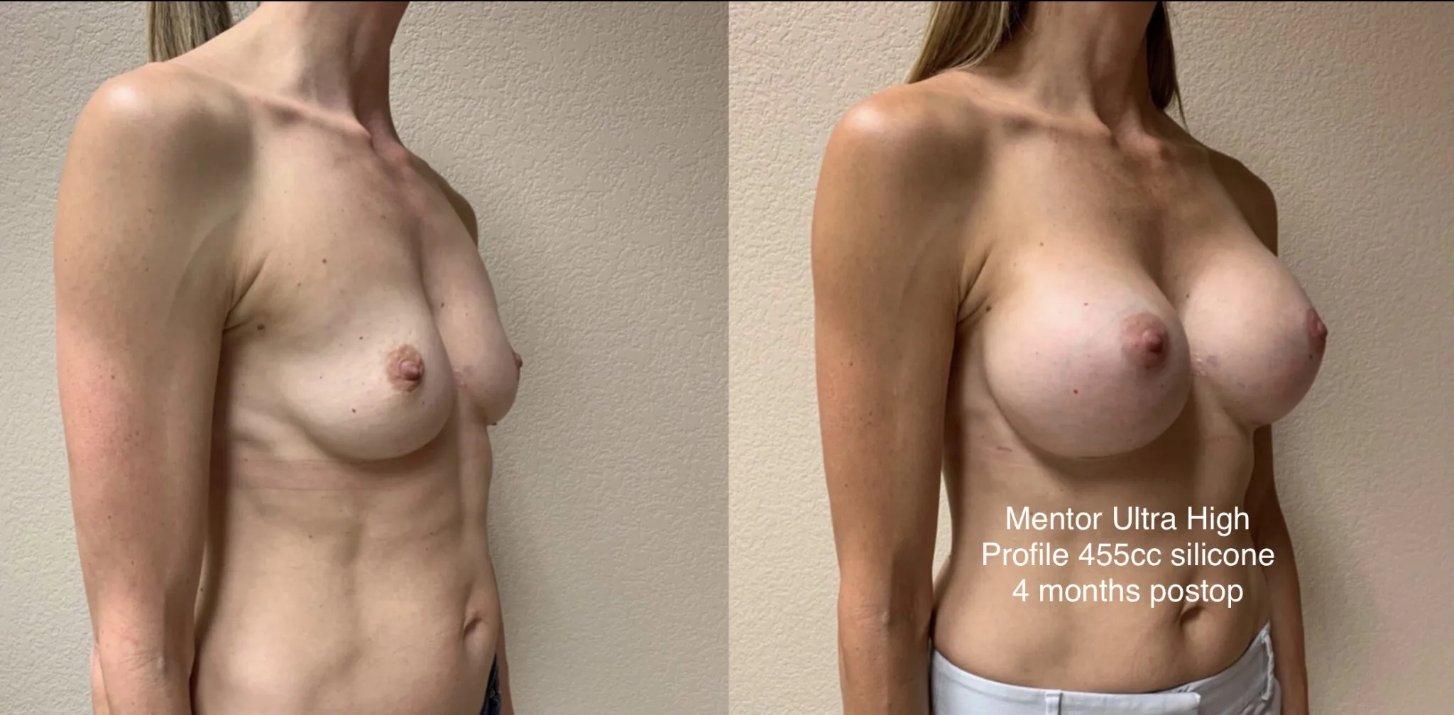 BREAST AUGMENTATION Before & After Case Number 00045