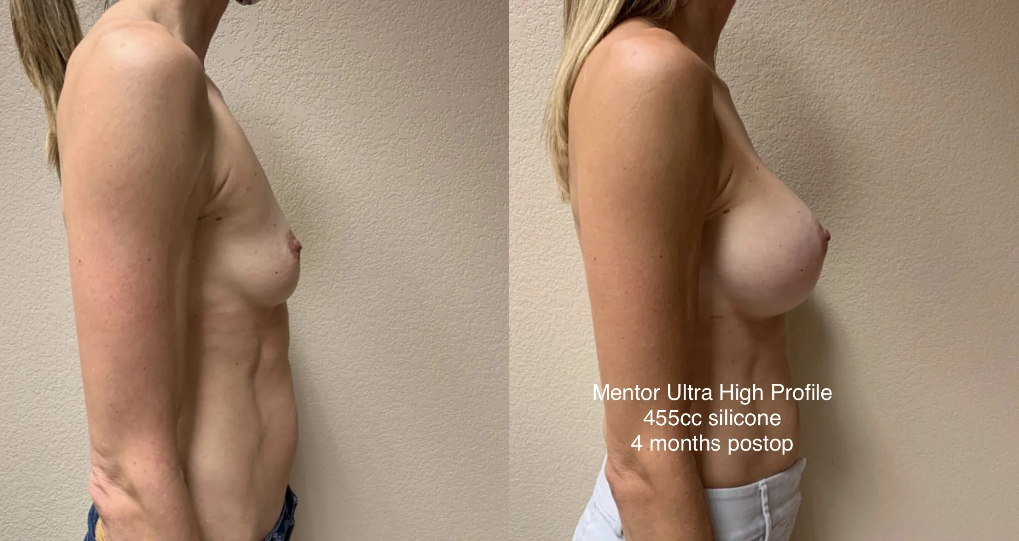BREAST AUGMENTATION Before & After Case Number 00045