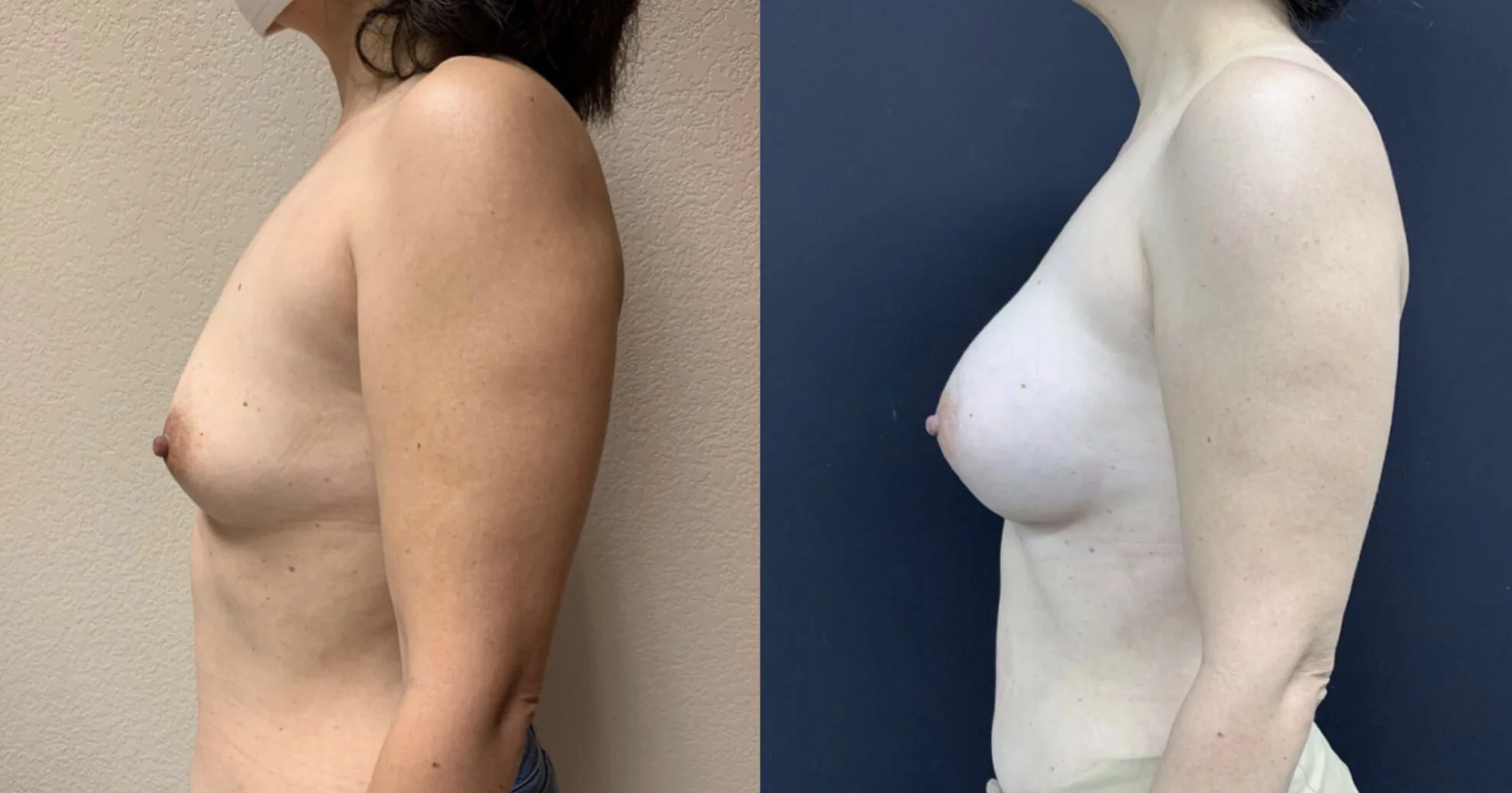 BREAST AUGMENTATION Before & After Case Number 00046