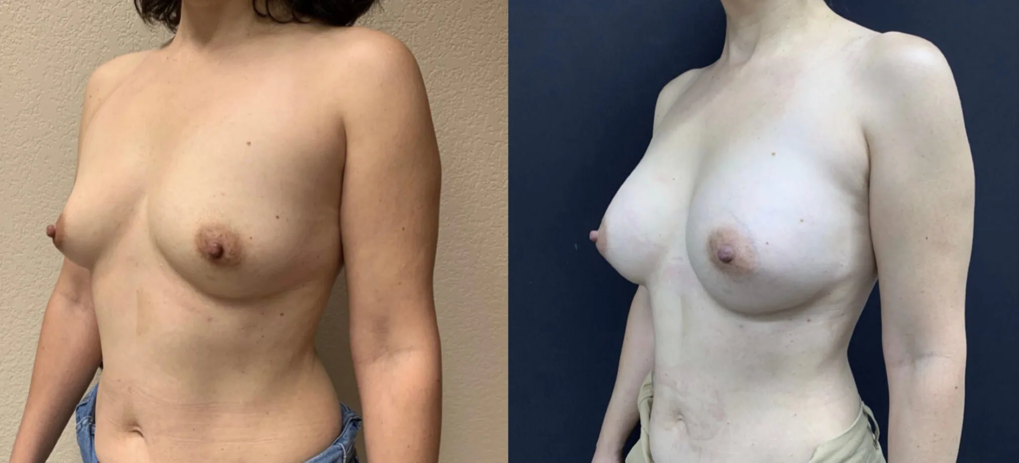 BREAST AUGMENTATION Before & After Case Number 00046