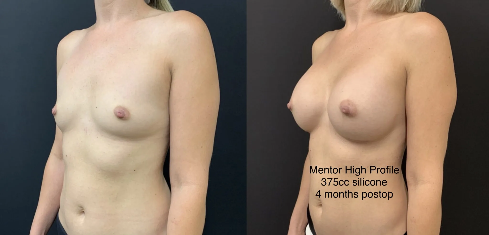 BREAST AUGMENTATION Before & After Case Number 00048