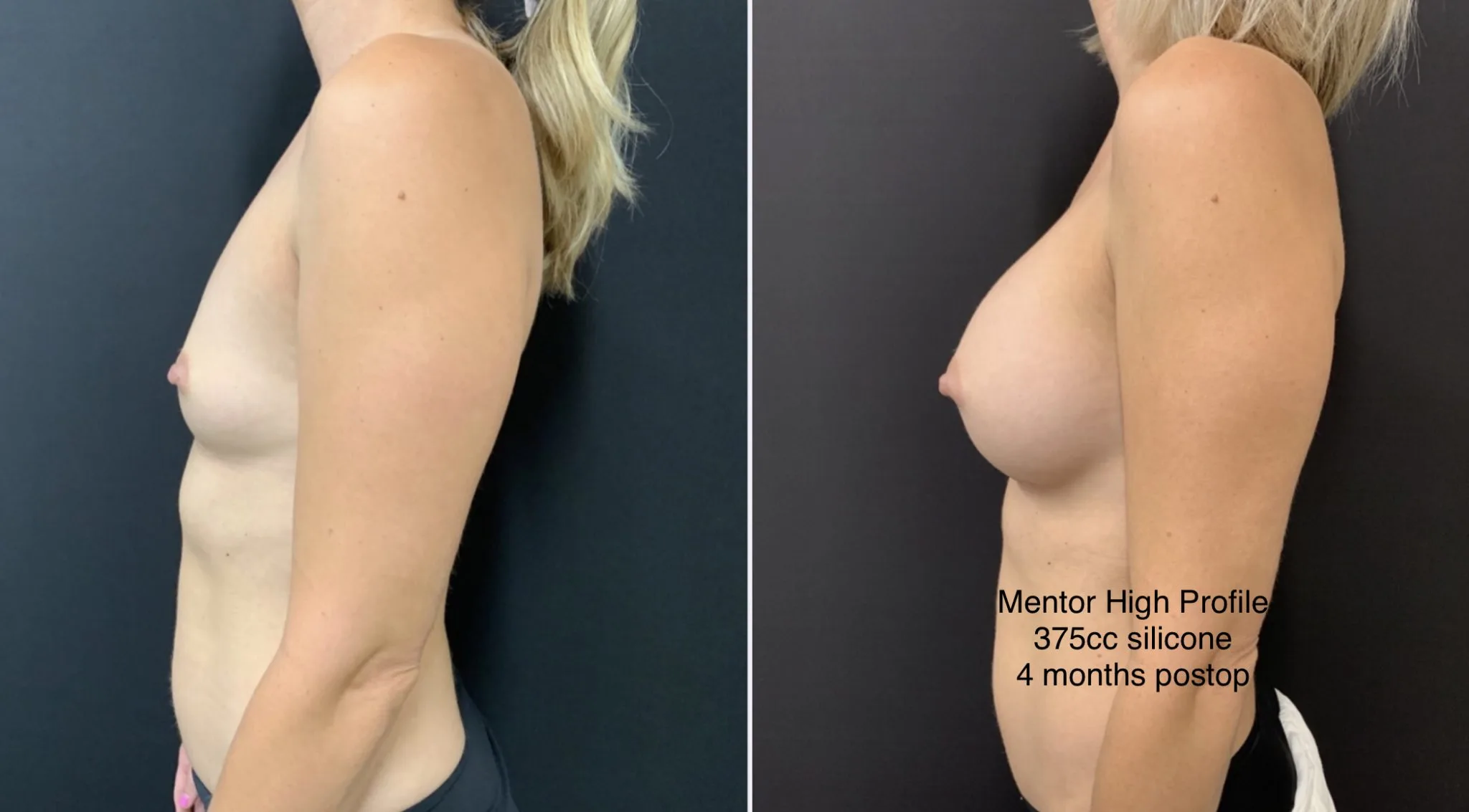 BREAST AUGMENTATION Before & After Case Number 00048