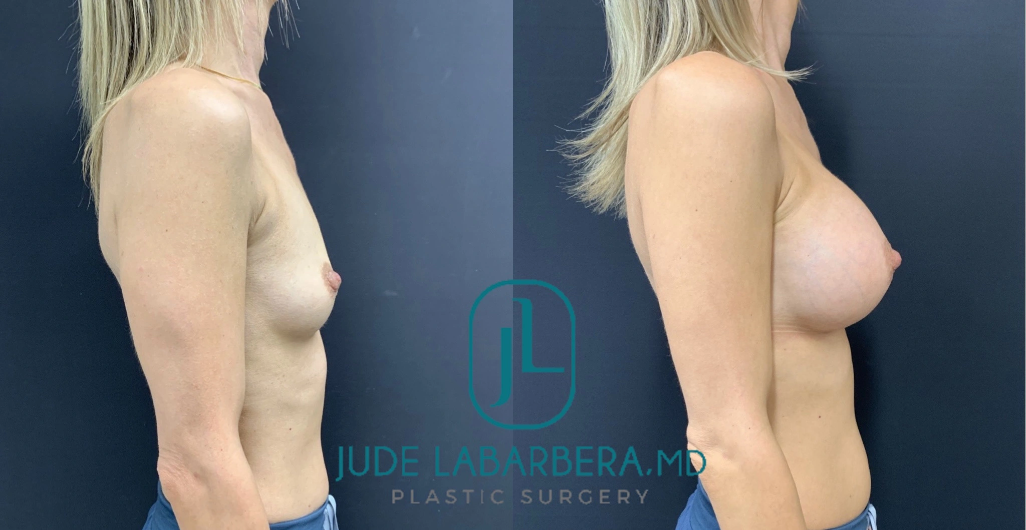 BREAST AUGMENTATION Before & After Case Number 00056