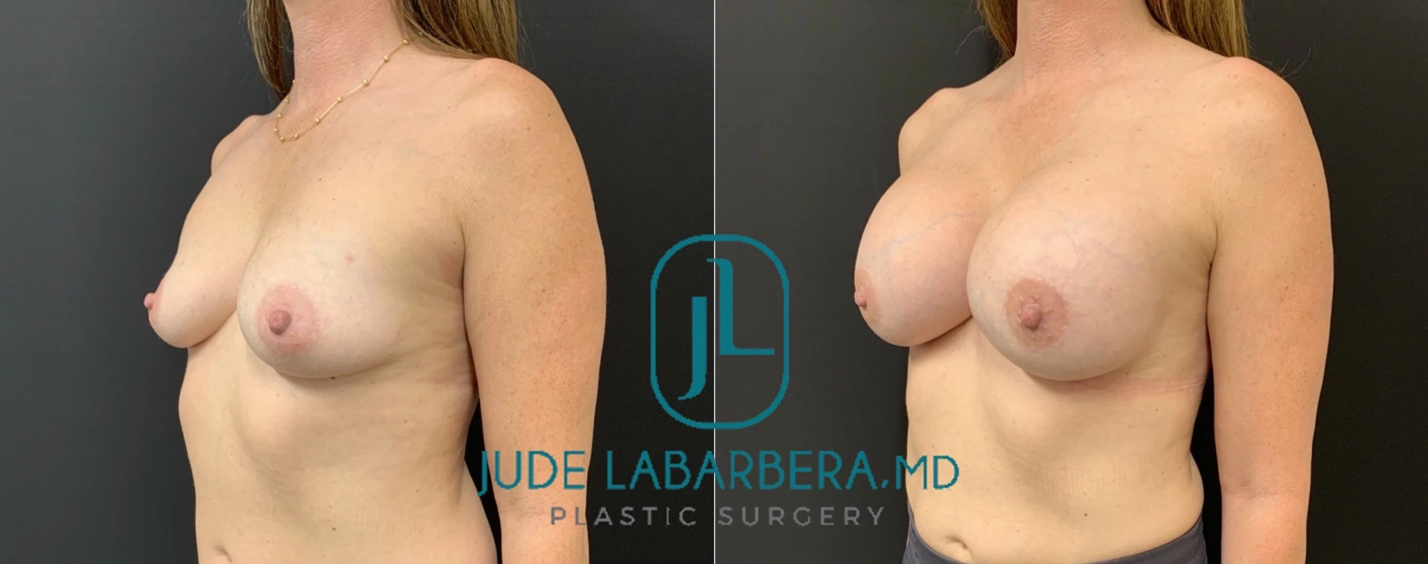 BREAST AUGMENTATION Before & After Case Number 0006