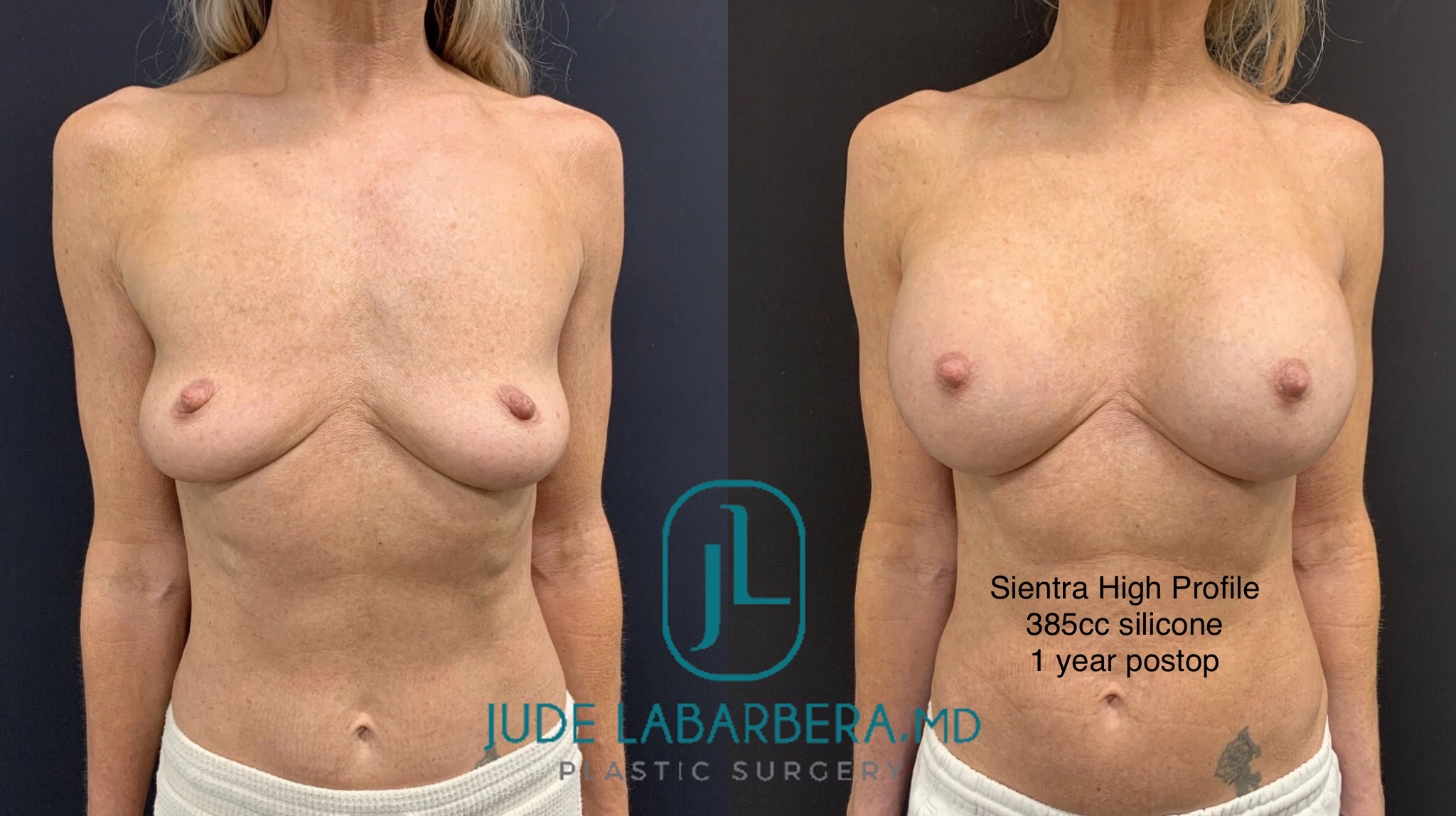 BREAST AUGMENTATION Before & After Case Number 00061