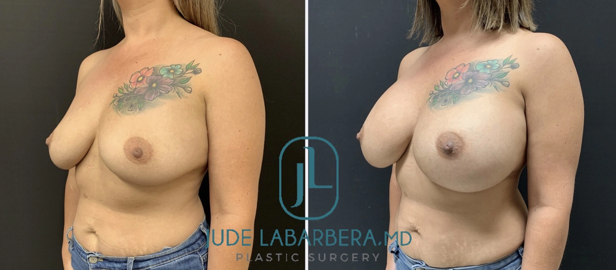BREAST AUGMENTATION Before & After Case Number 00062