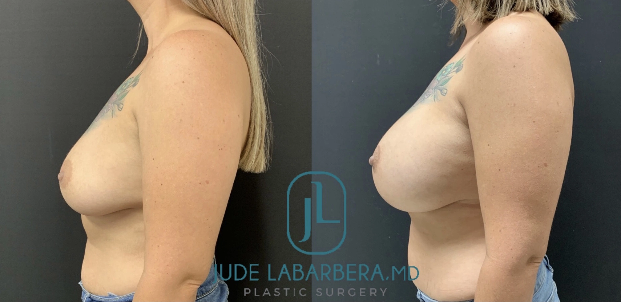 BREAST AUGMENTATION Before & After Case Number 00062
