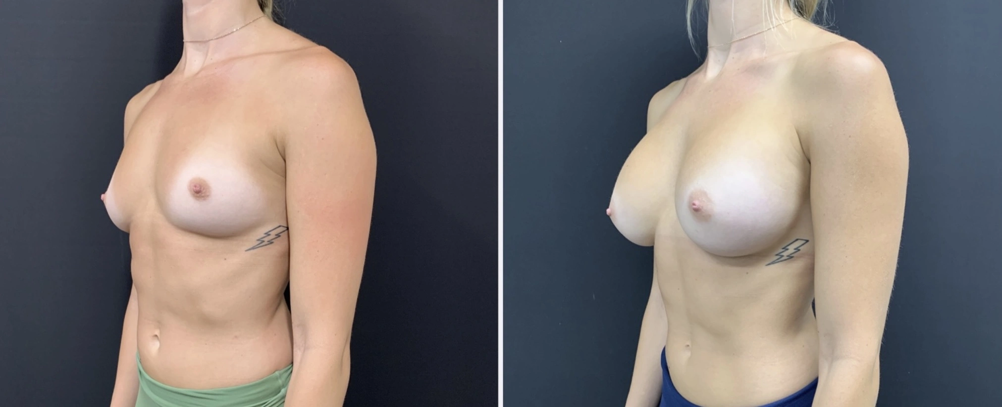 BREAST AUGMENTATION Before & After Case Number 00067
