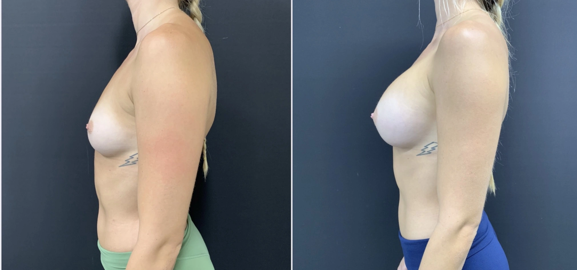 BREAST AUGMENTATION Before & After Case Number 00067