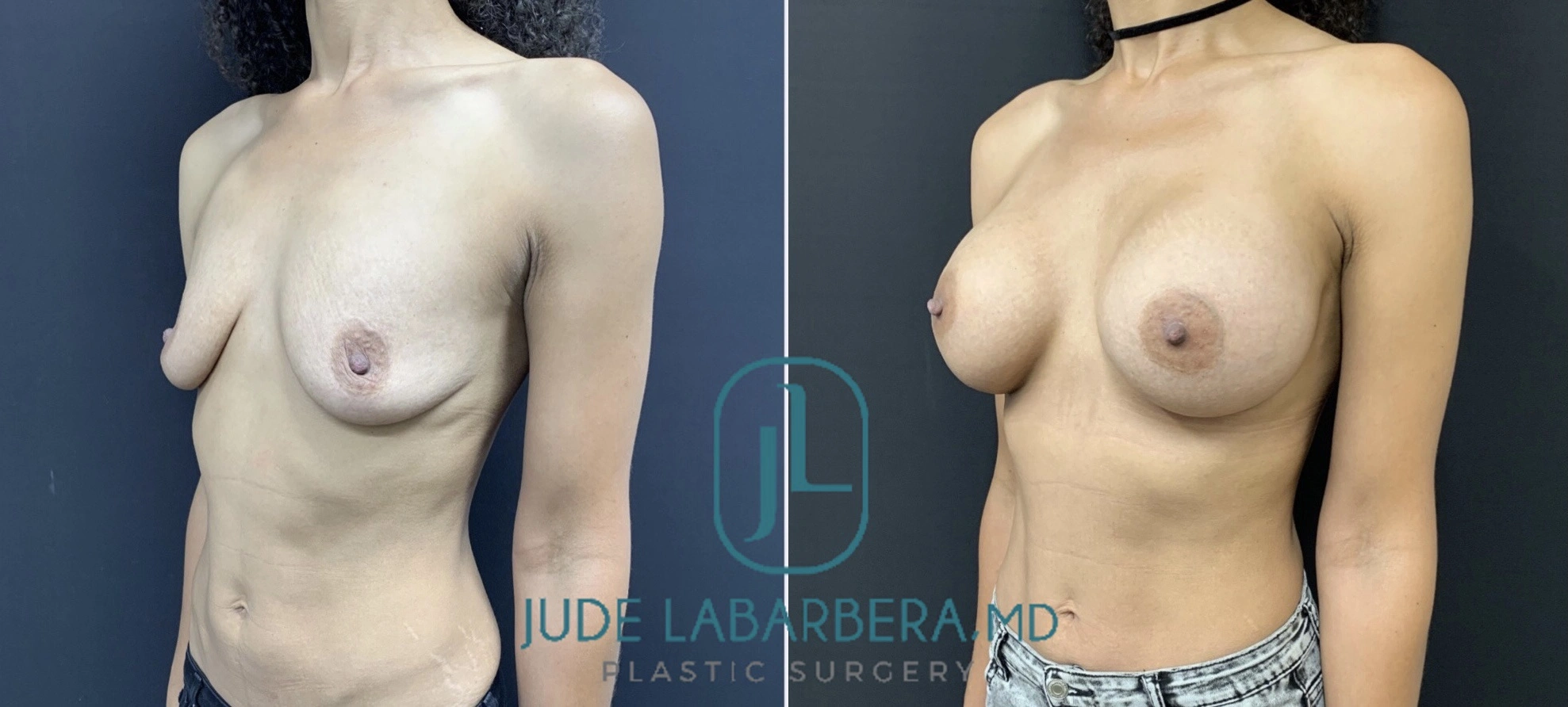 BREAST AUGMENTATION Before & After Case Number 00070