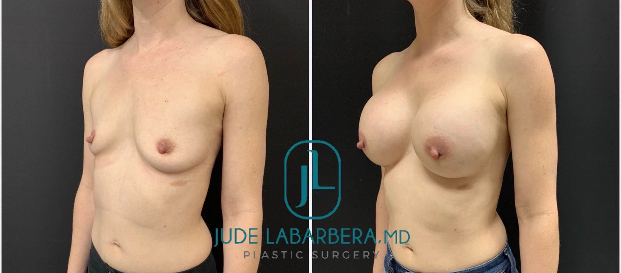 BREAST AUGMENTATION Before & After Case Number 00072