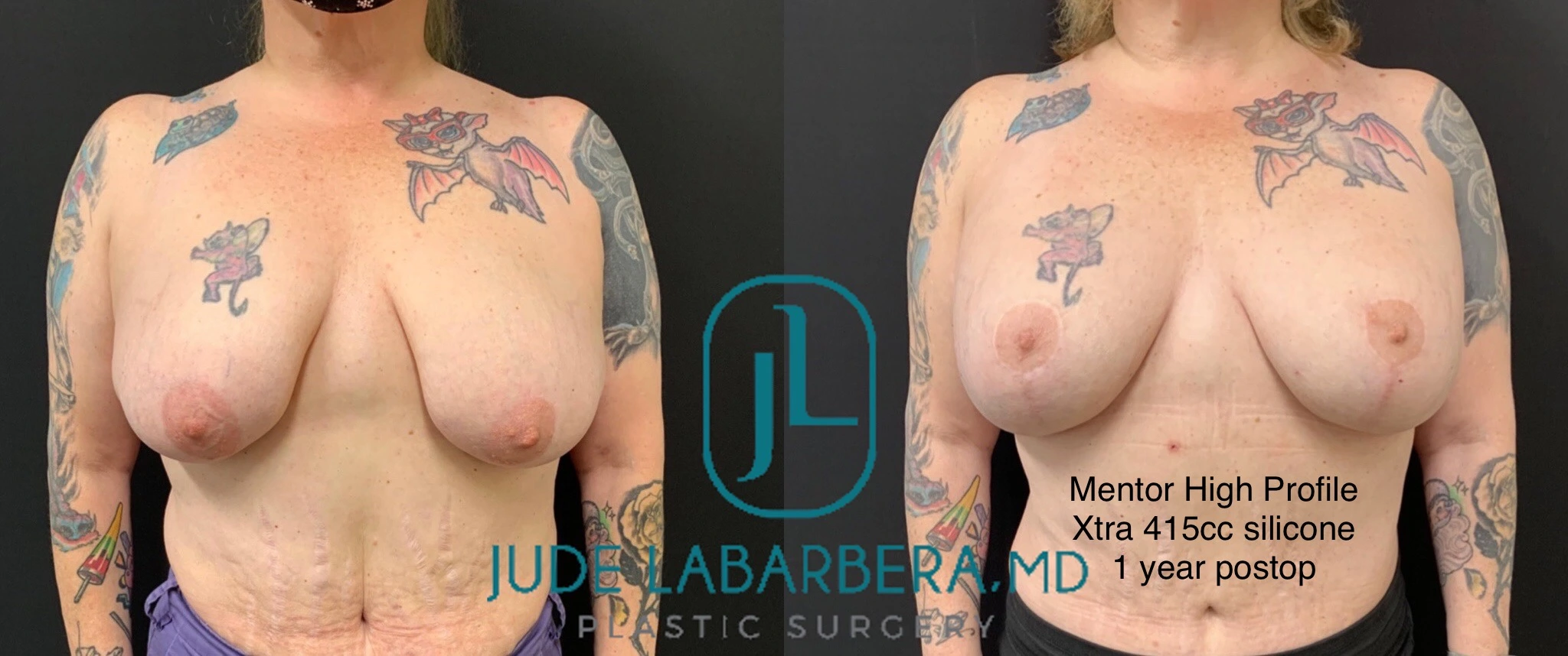 BREAST AUGMENTATION WITH LIFT Before & After case 105
