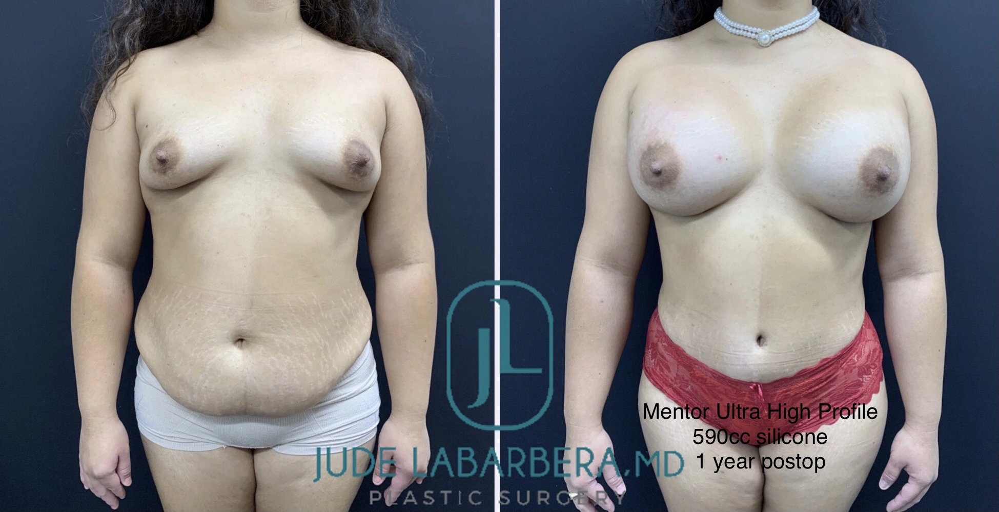 BREAST AUGMENTATION WITH LIFT Before & After case 26