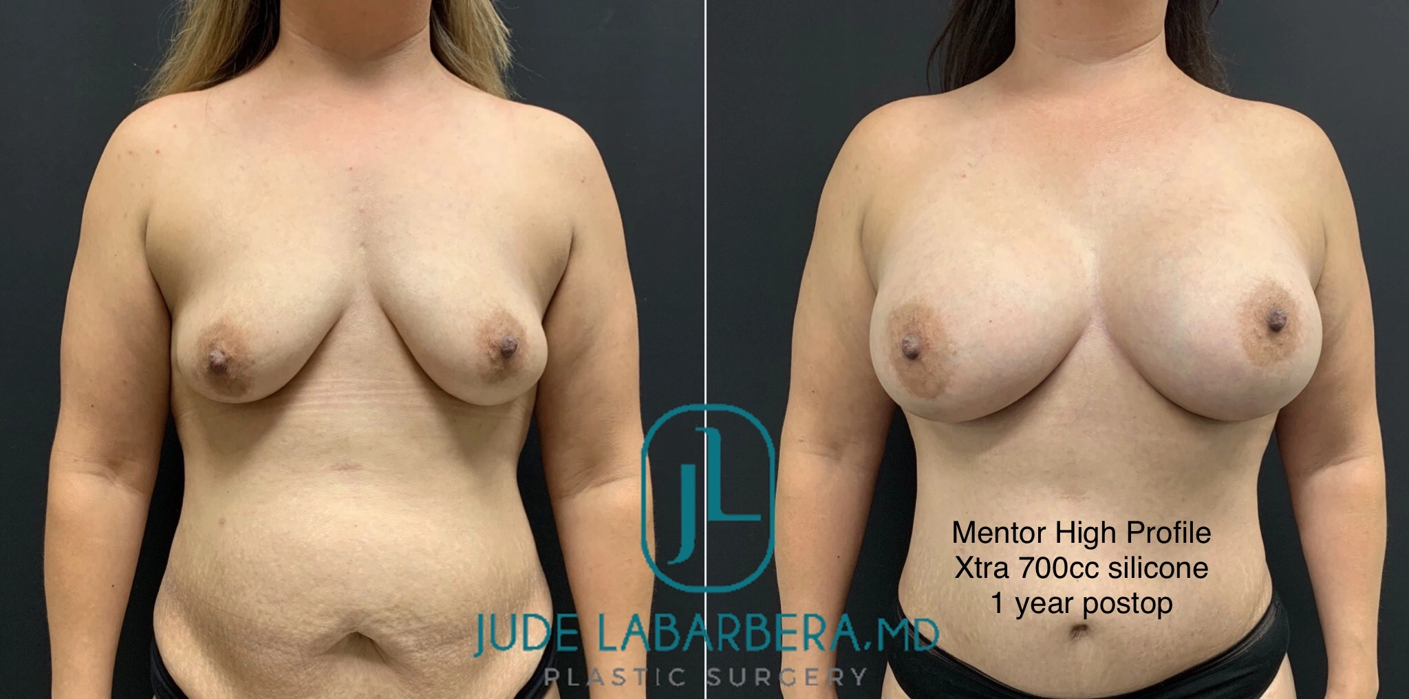 BREAST AUGMENTATION WITH LIFT Before & After case 41