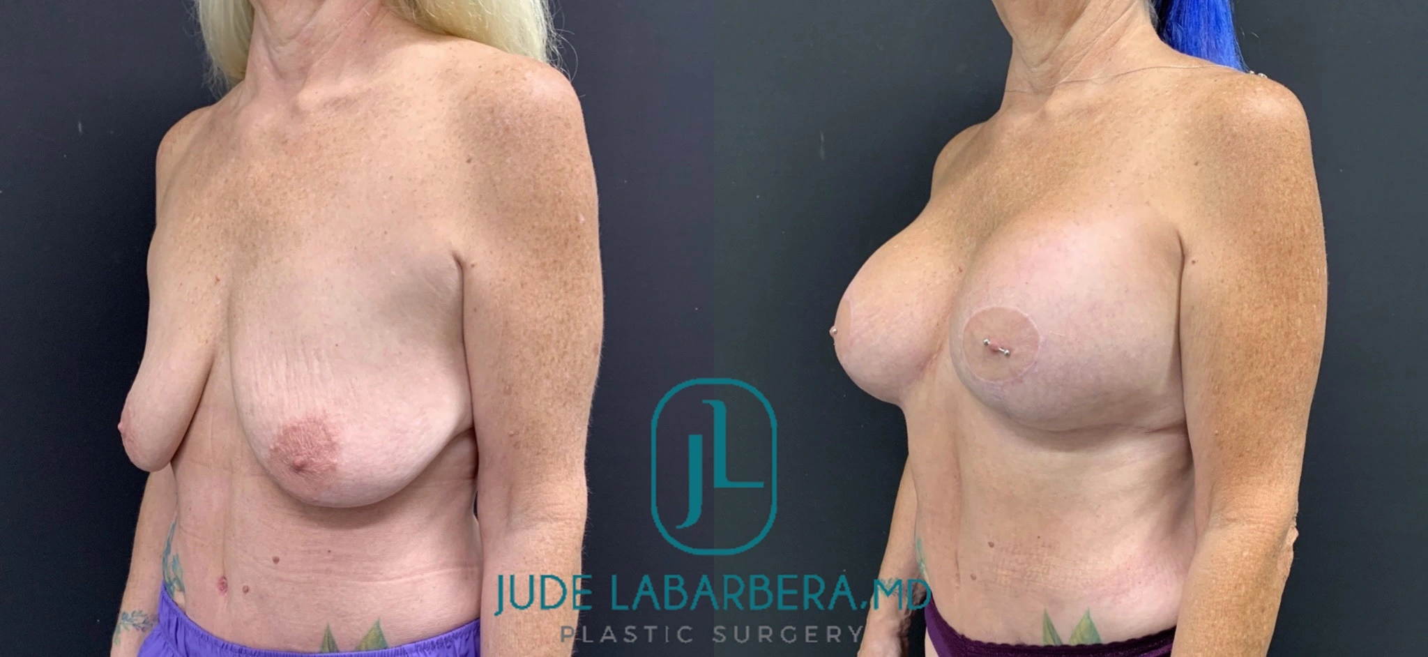 BREAST AUGMENTATION WITH LIFT Before & After Case Number 00012