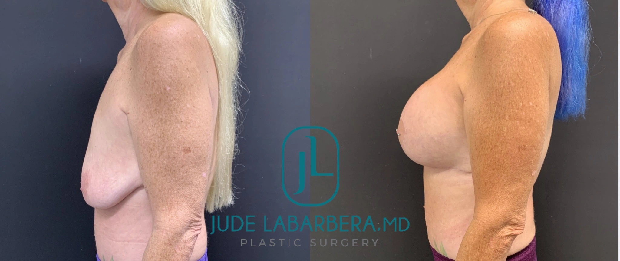 BREAST AUGMENTATION WITH LIFT Before & After Case Number 00012