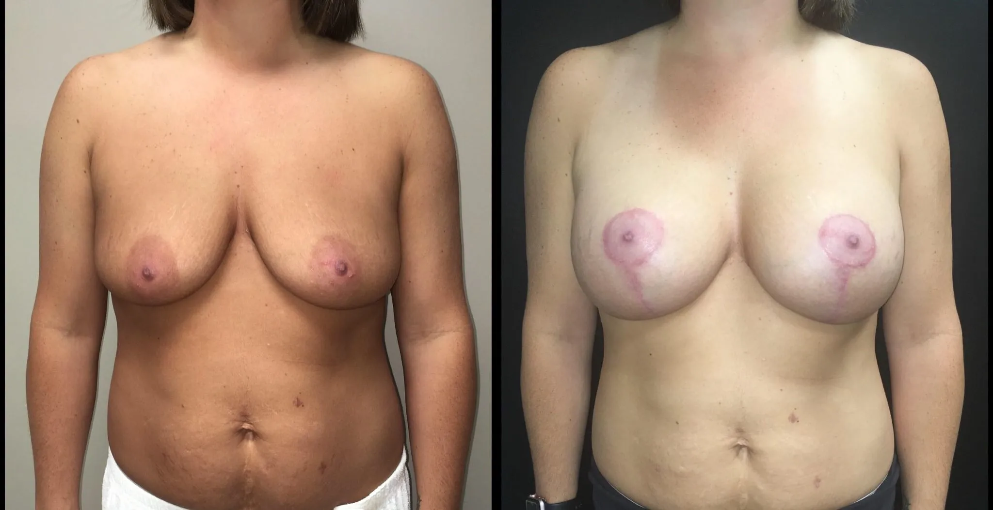 BREAST AUGMENTATION WITH LIFT Before & After Case Number 0005